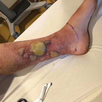 Charlotte Murphy chemical burns on leg from Wild Parsnip
