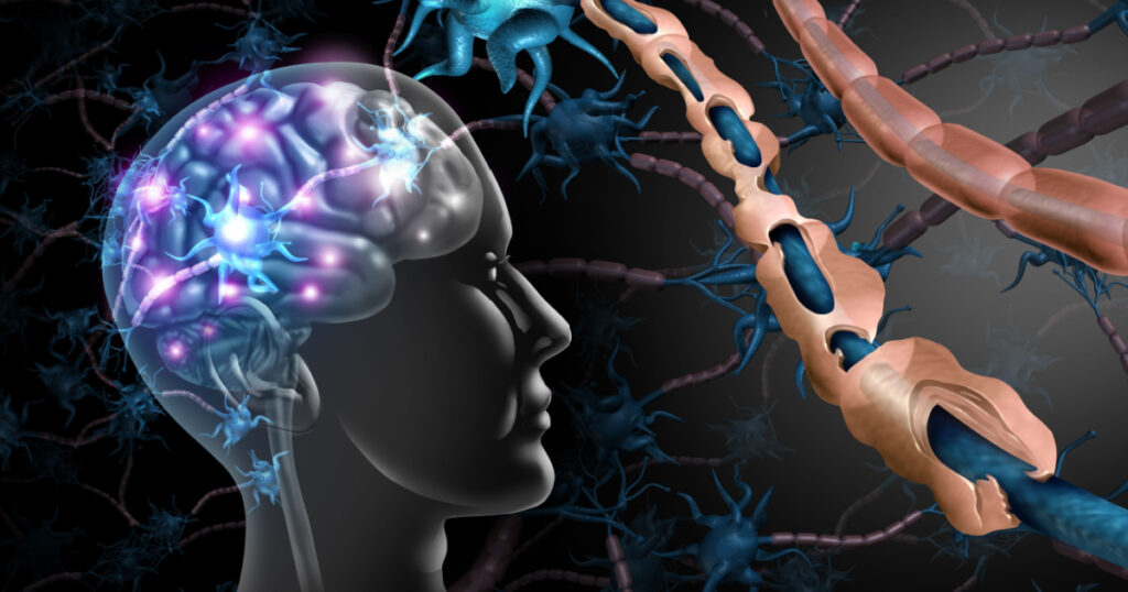 Stock Illustration ID: 1436984567

Multiple sclerosis nerve disorder and damaged myelin or MS autoimmune disease with healthy nerve with exposed fibre with scarred cell sheath loss with 3D illustration elements.
