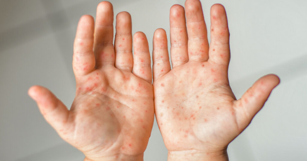 Enterovirus Leg arm mouth Rash on the body of a child Cocksackie virus