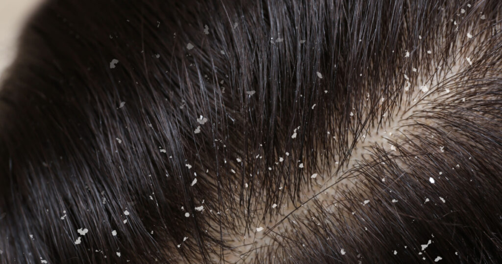 Woman with dandruff in her dark hair, closeup view
