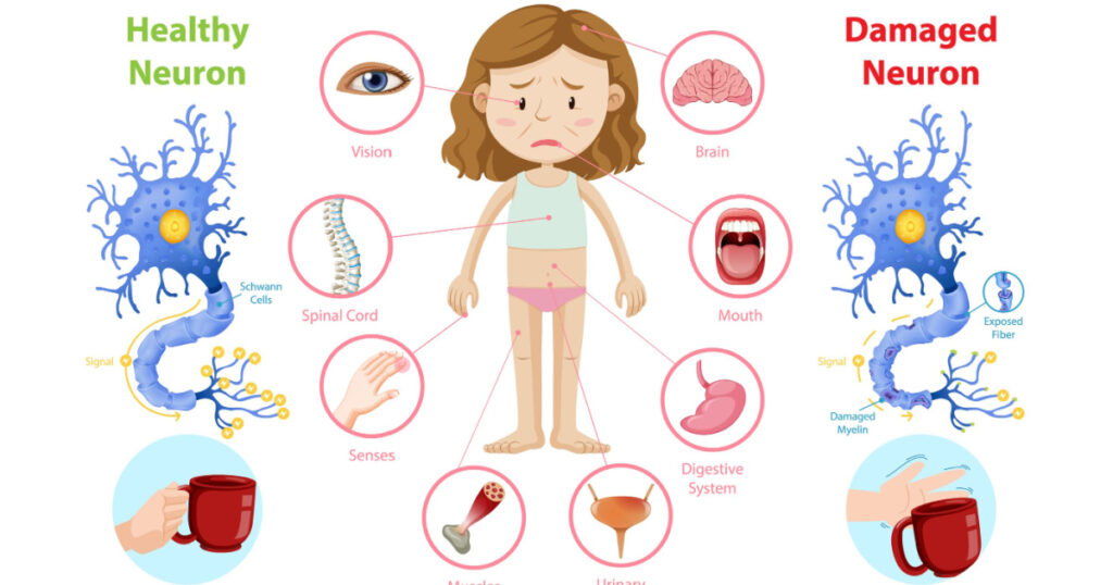 Multiple sclerosis (MS) symptoms information infographic illustration
