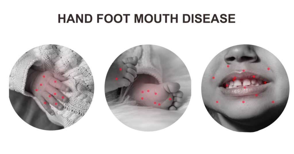 A bunch of hand foot mouth disease. Set of baby body details in circles isolated on white background. modern line art collage
