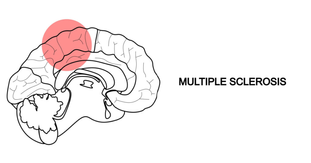 Multiple sclerosis banner. Multiple sclerosis banner design from Diseases collection. Simple element vector illustration on white background.

