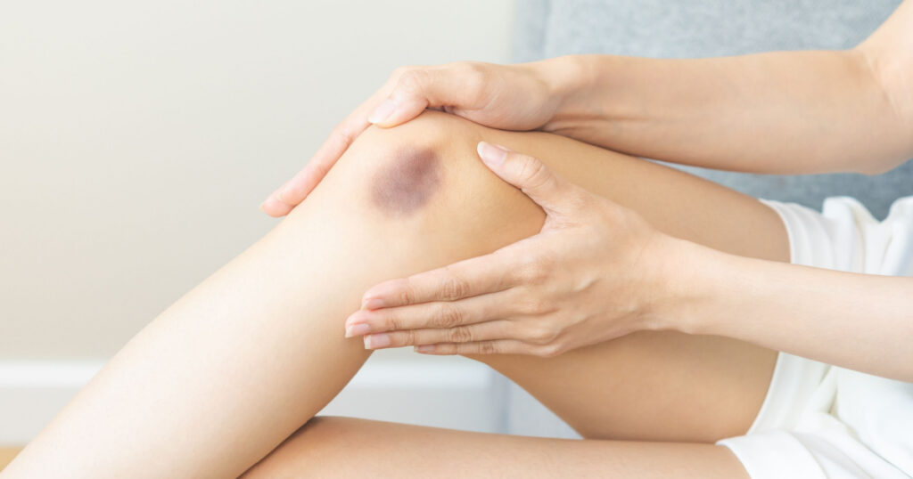 Close up of stain bruise wound on leg, contusion asian young woman, girl on joint knee from an accident fell down, hand in healing injury by massage hematoma blood. Extravasation blue, purple on skin.