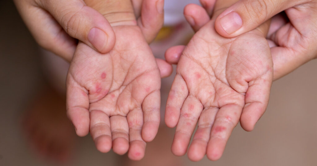 Parents hold the hands of a child with HFMD