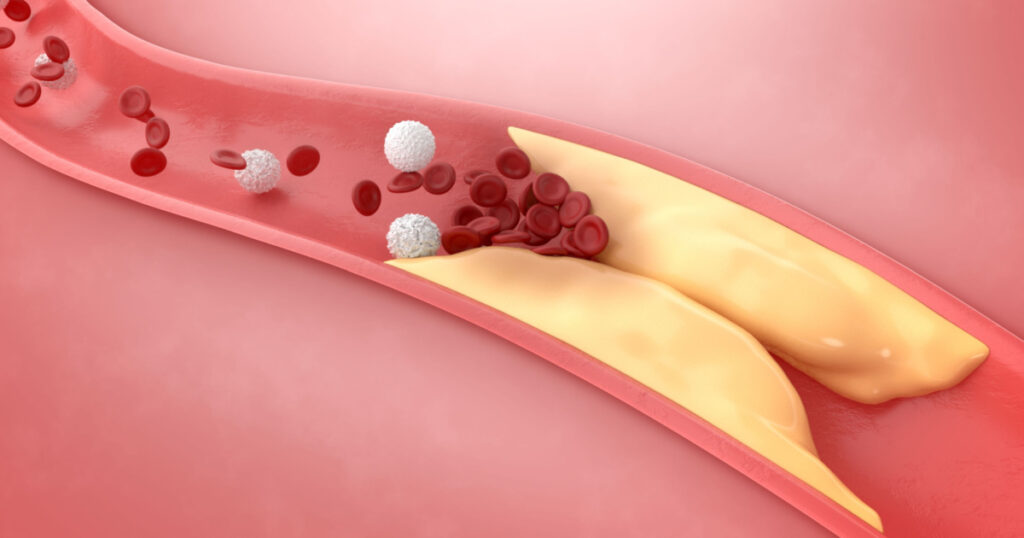 Thickened Arteries and Veins, Coronary heart disease, High cholesterrol, 3D Rendering.
