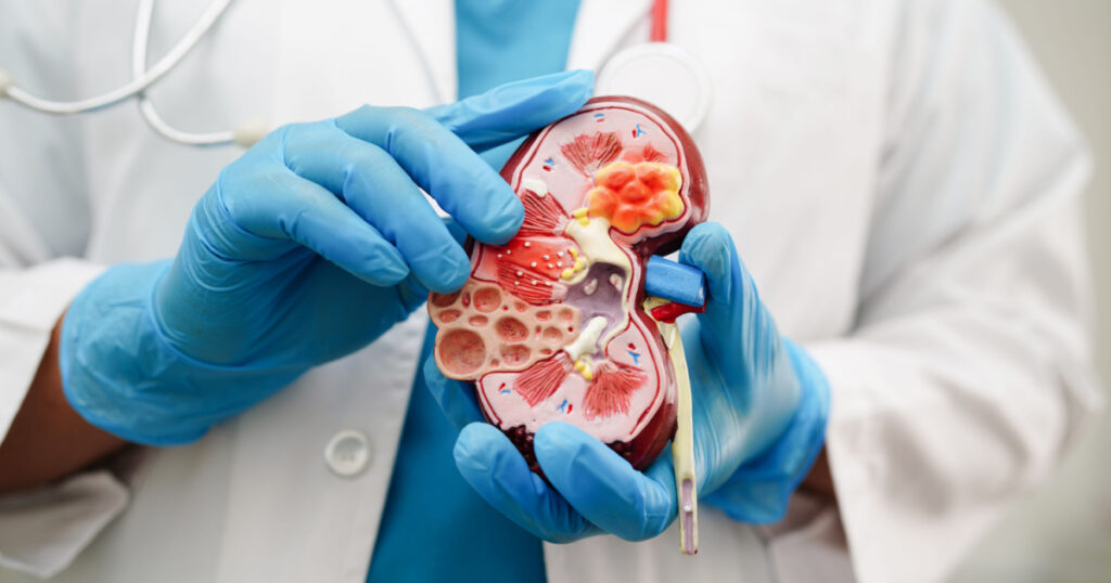Chronic kidney disease, doctor holding model for treatment urinary system, urology, Estimated glomerular filtration rate eGFR.
