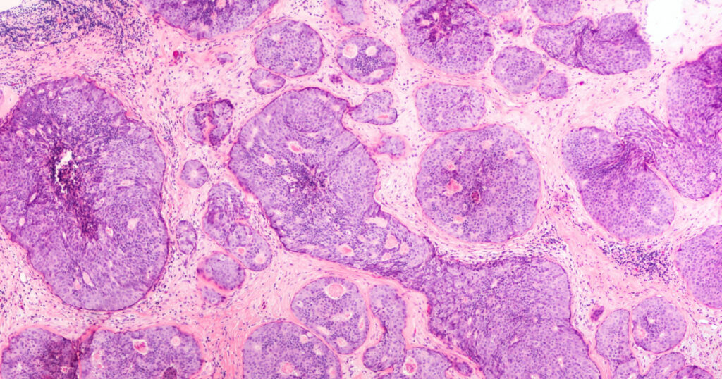 Breast cancer core biopsy - ductal carcinoma in situ (DCIS) detected by screening mammography: Tumor cells are confined to the mammary ducts. There is branching and budding with no invasion present.