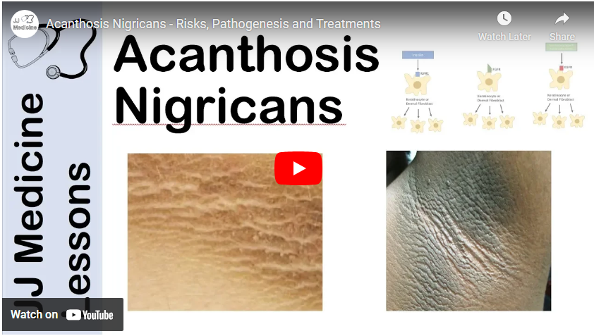 Acanthosis video