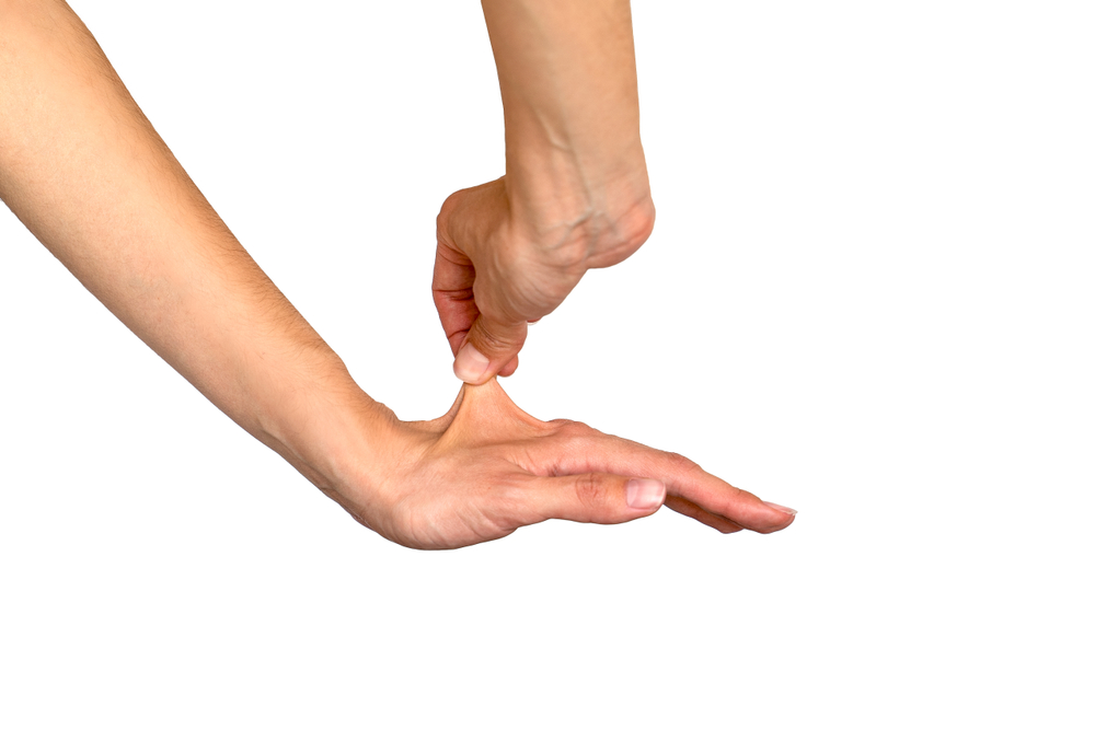 Woman stretching the skin of her hand