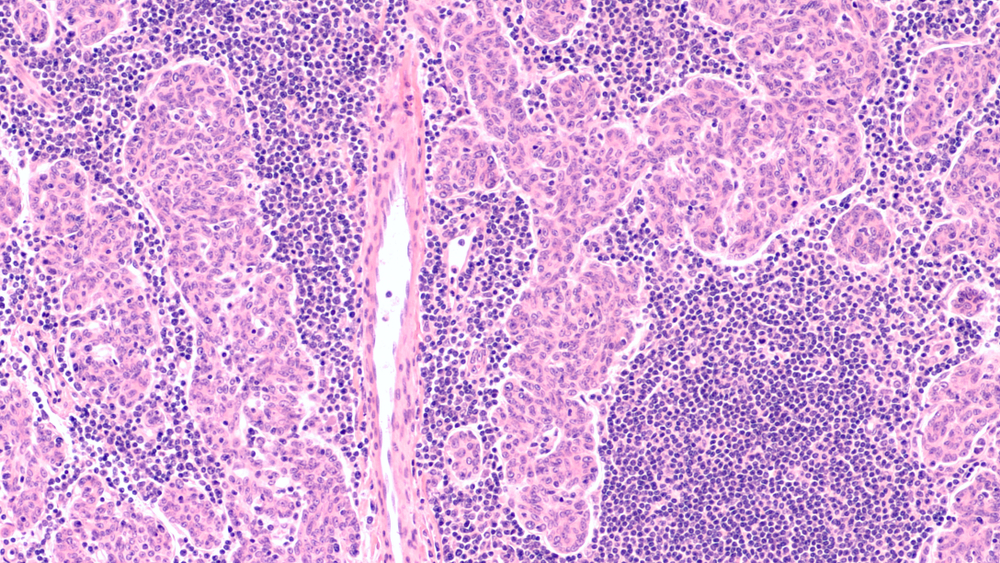 Microscopic image (photomicrograph) of a thymoma, a tumor of thymic gland origin with both epithelial and lymphoid components. It may be seen in association with myasthenia gravis.