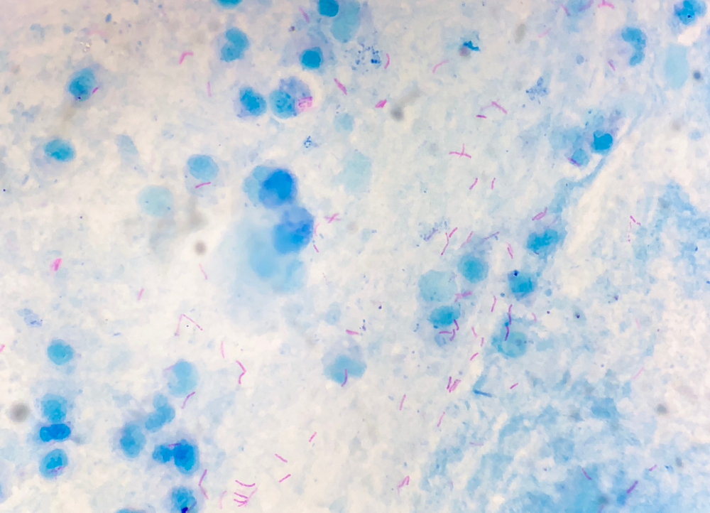 Mycobacterium tuberculosis in Sputum under light microscope