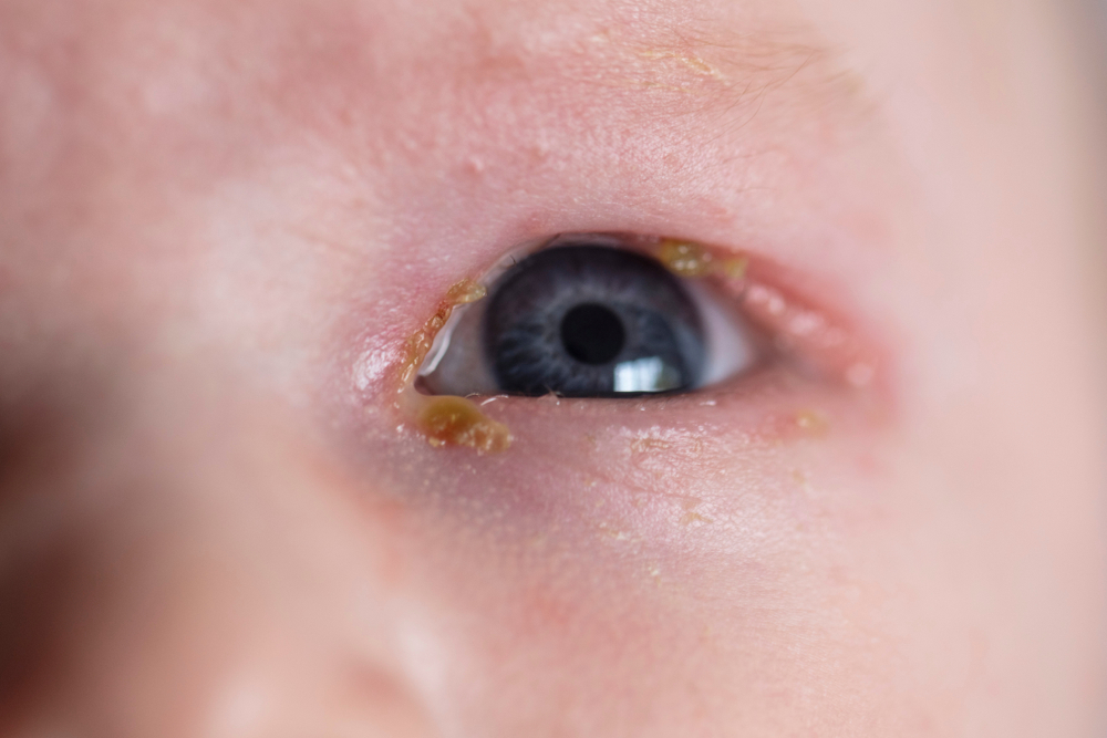 A close up of a young baby with a common sore sticky eye infection
