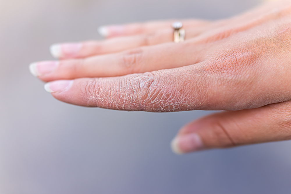 Dry cracked skin macro closeup of index finger of female young woman's hand showing eczema medical condition called dyshidrotic pompholyx or vesicular dyshidrosis
