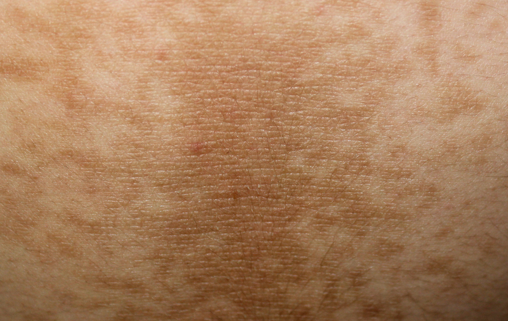 A case of acanthosis nigricans in a male with diabetes