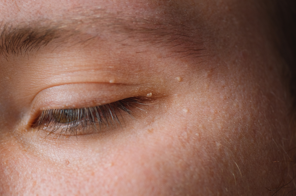 Milia (Milium) - pimples around eye on skin. Eyes of young man with small papillomas on eyelids or growths on skin. Face closeup.