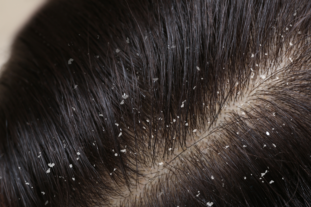 Woman with dandruff in her dark hair, closeup view