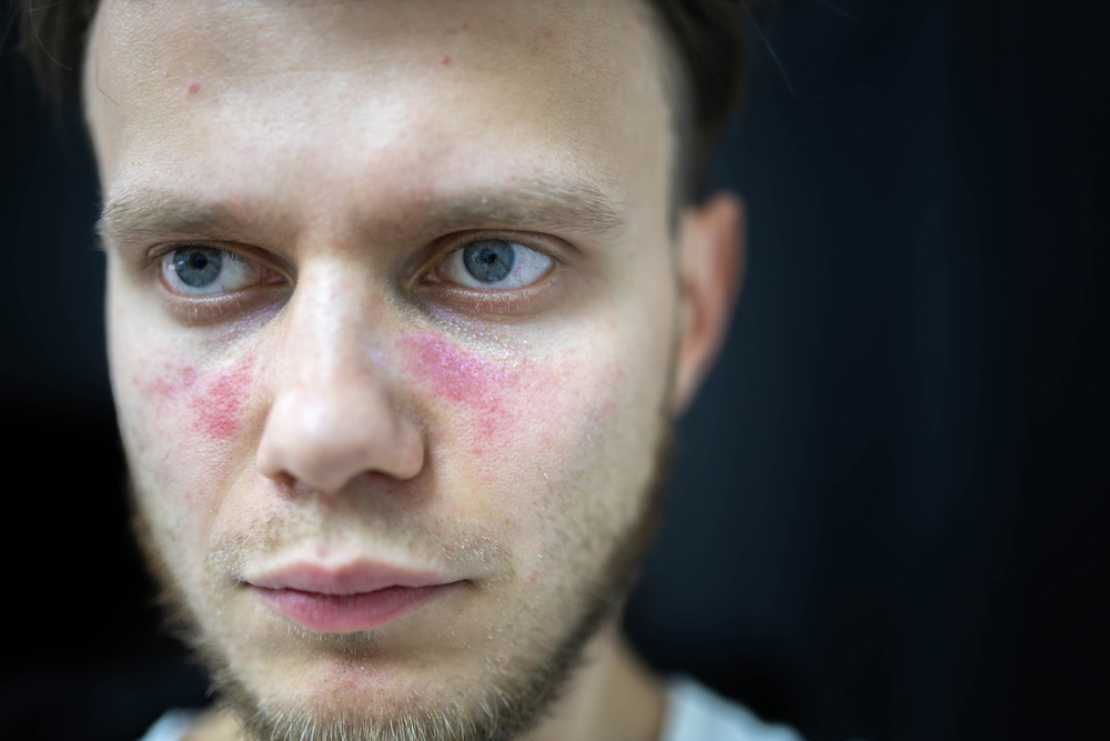 age spots of redness on the face, a young man is sick systemic lupus erythematosus
