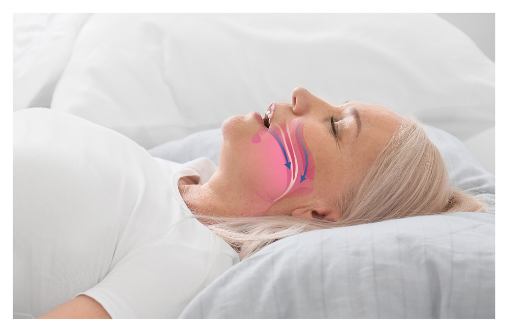 Illustration showing airway during obstructive sleep apnea