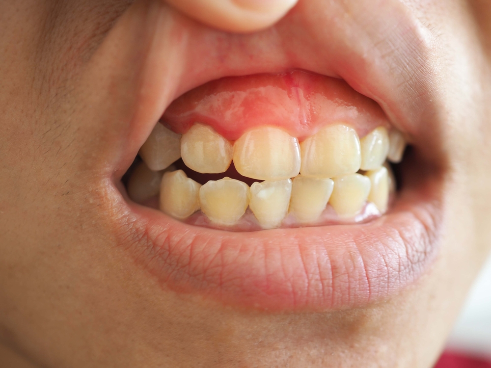 Gum infection in the woman's mouth. Gingivitis,oral care, dentist concept. closeup photo, bluured.

