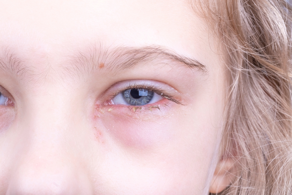 close-up. a girl with white hair. a tear flows from the eye, it is red, there is a discharge of pus. skin rash. very strong fragmentation. doctor's examination
