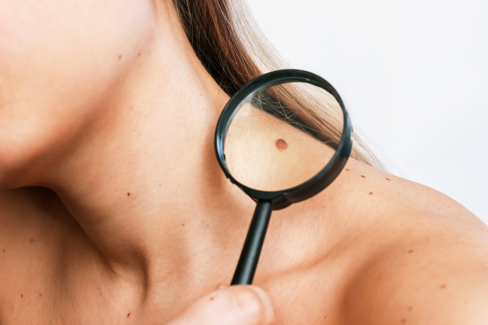 Close-up of a big mole on a young woman's neck magnified with a magnifying glass isolated on a gray background. The effect of sunlight on the skin
