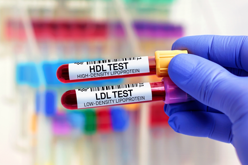 Blood samples of patient for High Density Lipoprotein HDL and Low Density Lipoprotein LDL test in laboratory. Blood tubes for HDL High Density Lipoprotein and LDL Low Density Lipoprotein test