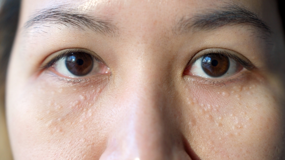 Syringoma milia milium cysts or seborrheic keratosis on asia people female face body care. Close-up young adult asian woman under eye small acne liver spot skin issue smile with pride look at camera.
