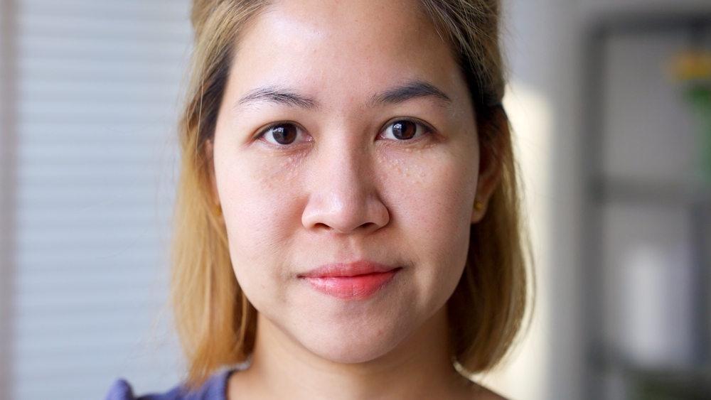 Syringoma milia milium cysts or seborrheic keratosis on asia people female face body care. Close-up young adult asian woman under eye small acne liver spot skin issue smile with pride look at camera.
