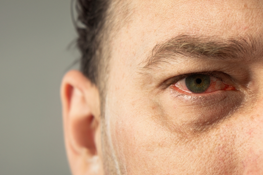 Red eye in a person. A close-up of a heavily bloodshot eye. Ophthalmia. Conjunctivitis. Copy space
