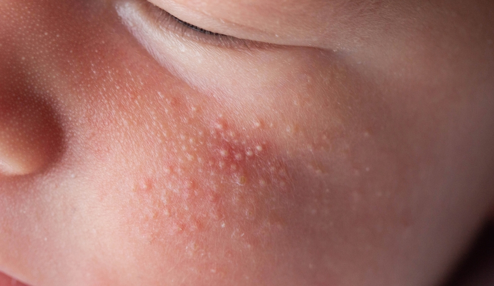 Allergic pimples in a newborn on the face. Pathogenesis, acne of newborns, close-up