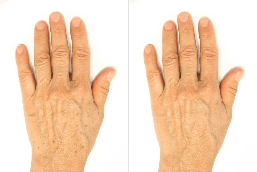 Age spots on the hands before and after removal using a lightening whitening cream. Rejuvenation procedure, laser treatment, peeling. Liver spots, lentigo, sun spots. Cosmetology and beauty concept
