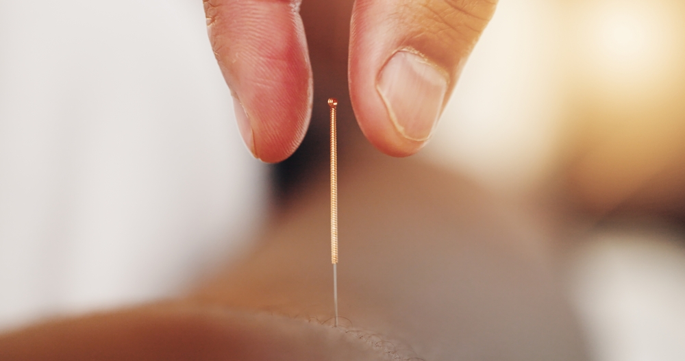 Acupuncture, needles and skin with hand in closeup, alternative medicine or healing therapy. Relax, muscle and body pain in clinic for health or wellness, support for immune system or stress injury