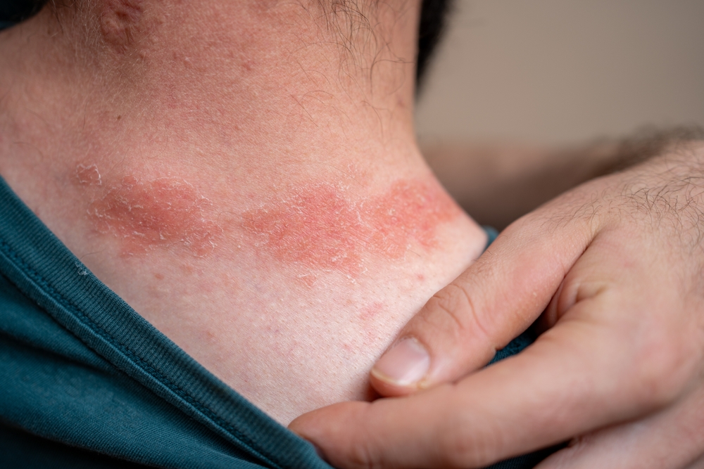 young man with skin spots around the neck. illness, diseases, allergies, psoriasis, eczema, dermatitis
