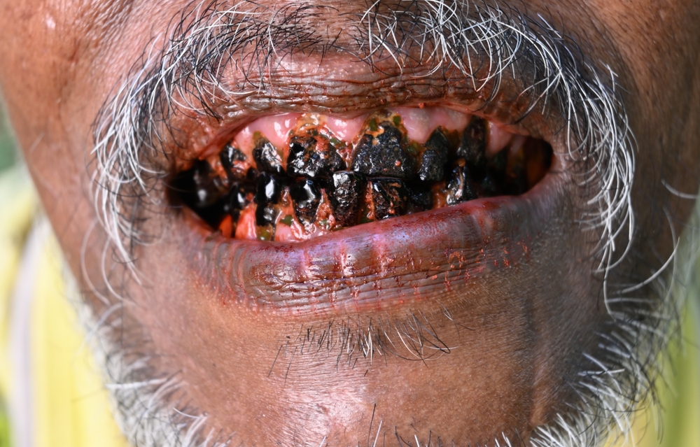 Kalutara, Sri Lanka, July 22, 2024 - View of the mouth and dirty teeth of an Asian male who is frequent chewing betel nuts. The teeth of this man became dark black due to excess chewing of betel nuts