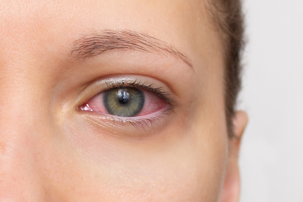 Close up of woman face with red eye. Swollen eyelids, irritation and itching of eyes caused by conjunctivitis, allergy, inflammation, infection. Dry eye syndrome
