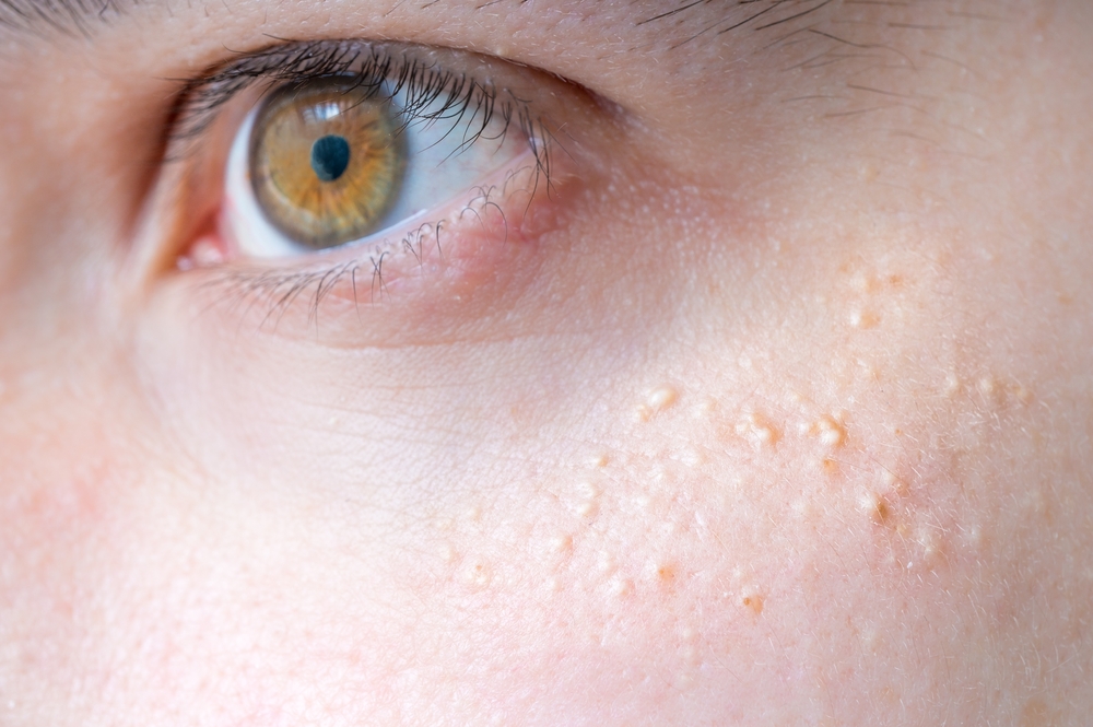 Milia (Milium) - pimples around eye on skin.
