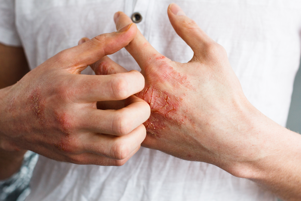 The problem with many people - eczema on hand. White background. Man itchind skin.
