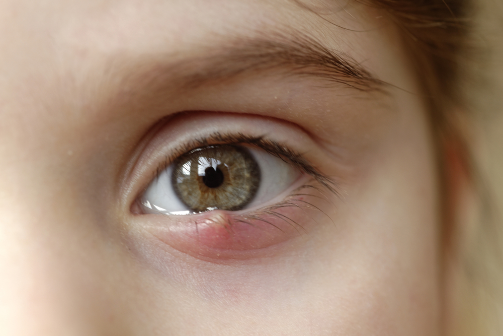 Close-up of a child's eye stye. Ophthalmic hordeolum disease.
