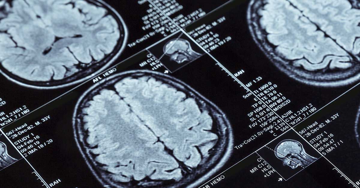Death of Teen Attributed to Tapeworm Eggs Found in His Brain from Eating Undercooked Pork