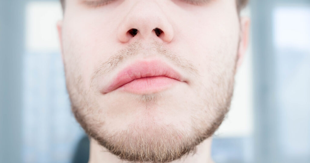 symptom of stroke cerebral. asymmetry of the face. angioedema