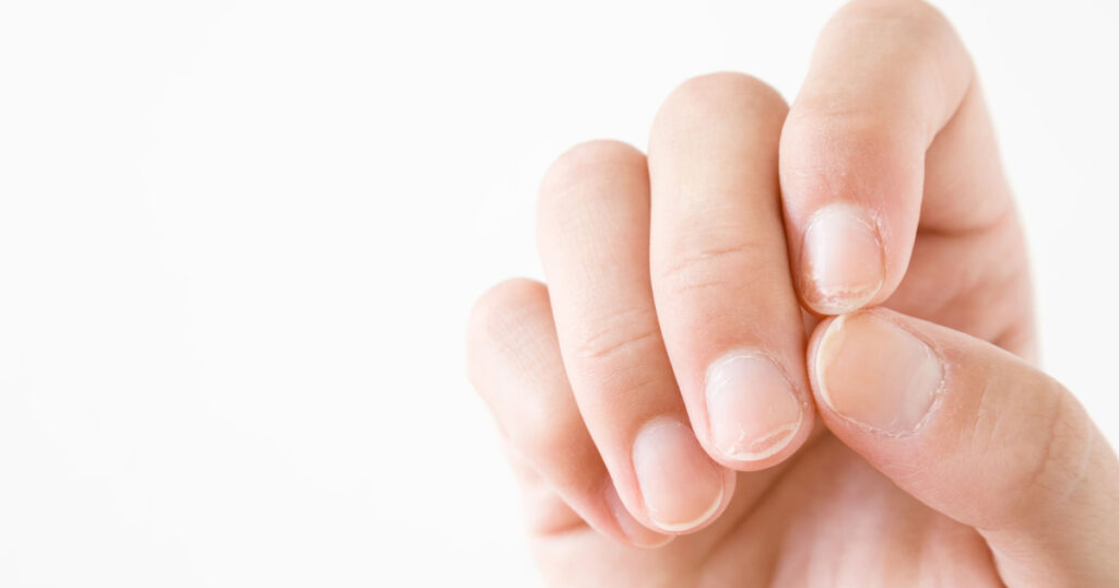 Hand on the white background. Dry, damage nails. Woman's issues. Problem and solution. Empty place for text.