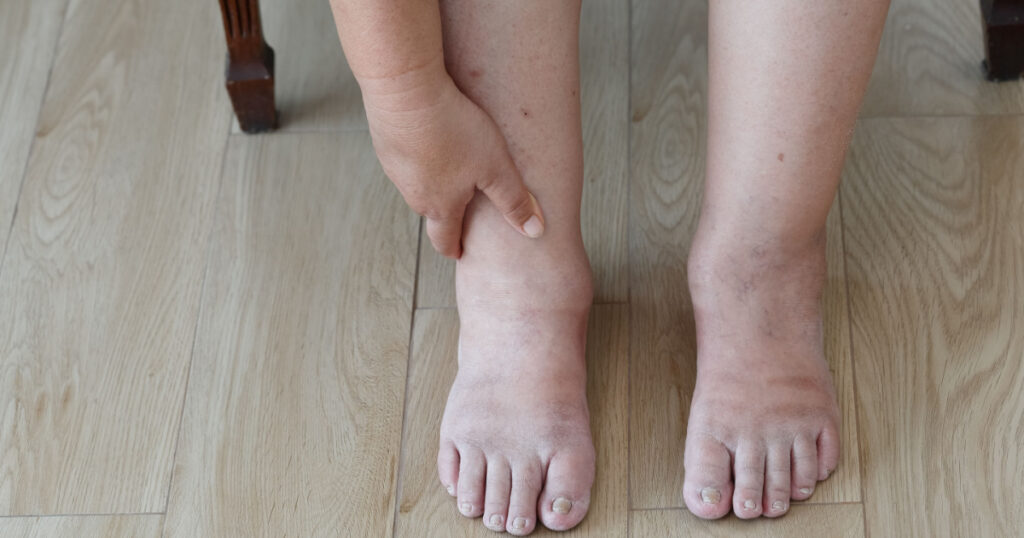 Senior woman swollen feet and leg