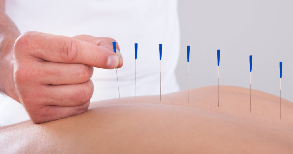 Young Beautiful Woman In An Acupuncture Therapy In A Spa Center