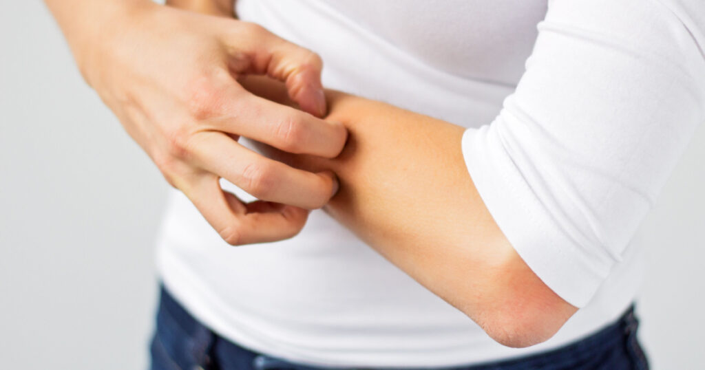 Woman scratching her arm.