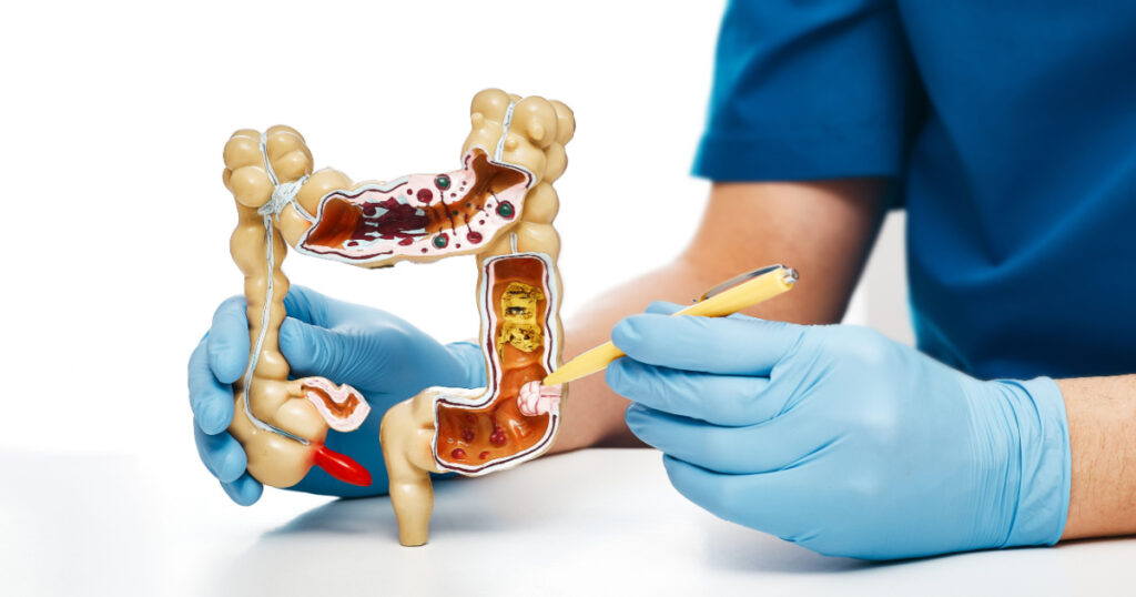 Cancer intestines. Gastroenterologist pointing pen tumor colon using an anatomical model for medical education