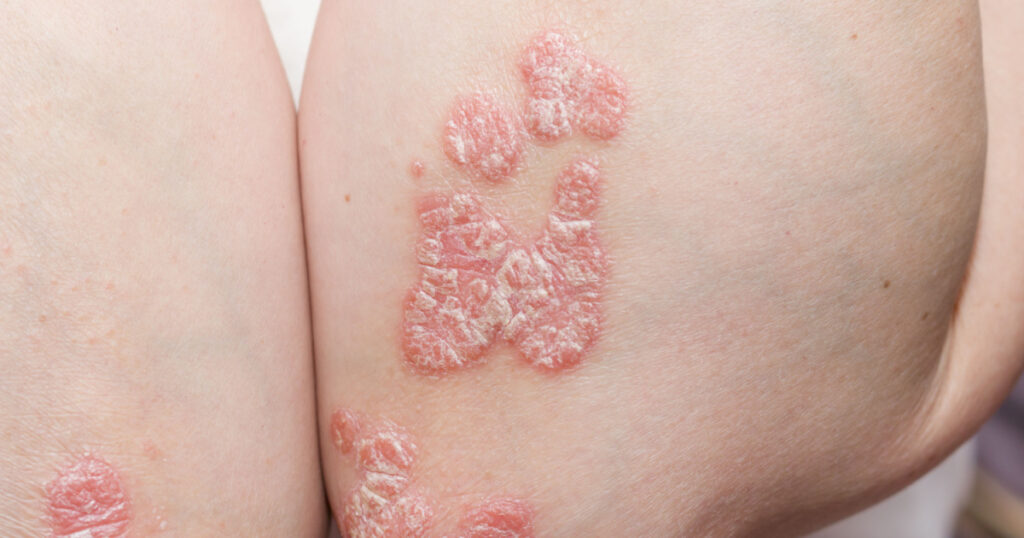 problem skin psoriasis on the body. exacerbation of psoriasis. stress and illness