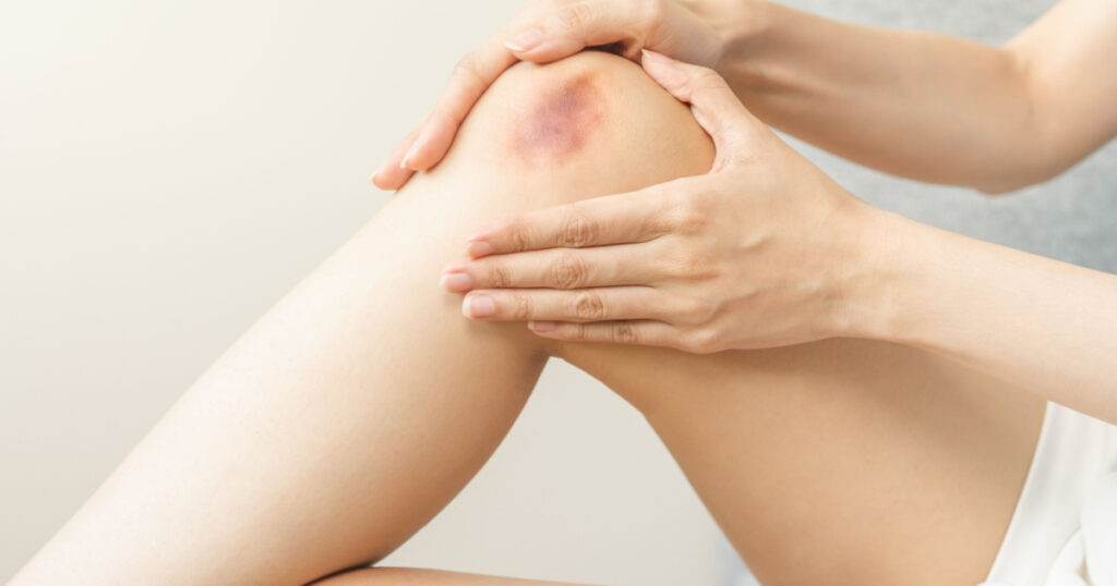Close up of stain bruise wound on leg, contusion asian young woman, girl on joint knee from an accident fell down, hand in healing injury by massage hematoma blood. Extravasation blue, purple on skin.