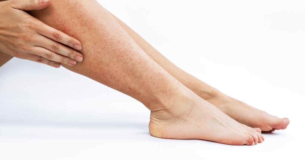 Irritation and redness on sensitive skin after epilation. Cropped shot of a young woman touching her legs with her hand after depilation isolated on a white background. Hair removal with wax, epilator