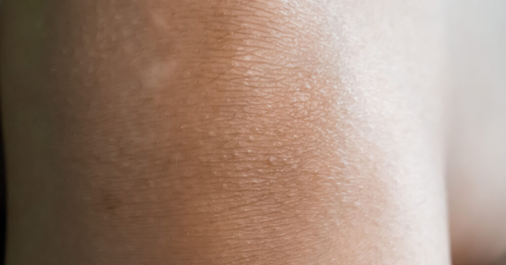 Hyperkeratosis also called toad skin or goose flesh at the skin of knee joint area. Closeup view.